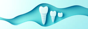 implants dentaires Cabinet Dentaire Cubzaguais