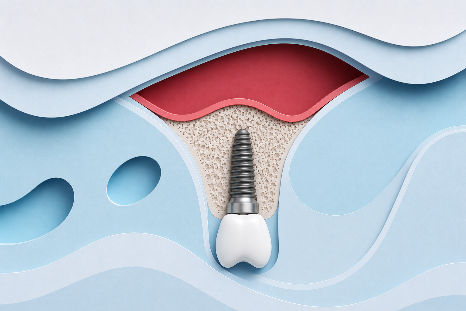 sinus lift, implant dentaire, Dr Watts; Saint-André-de-Cubzac