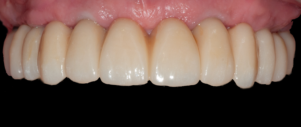 all-on 4, all-on 6, cabinet dentaire cubzaguais, Dr Gerome Watts, implant dentaire, implantologie, Bordeaux, Saint-André-de-Cubzac, Libourne, Cubzac-les-Ponts, Bordeaux, Gironde, esthétique dentaire, prothèse sur implant , 19 rue Nationale 33240