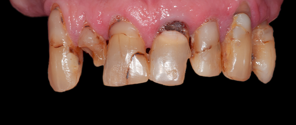 all-on 4, all-on 6, cabinet dentaire cubzaguais, Dr Gerome Watts, implant dentaire, implantologie, Bordeaux, Saint-André-de-Cubzac, Libourne, Cubzac-les-Ponts, Bordeaux, Gironde, esthétique dentaire, prothèse sur implant , 19 rue Nationale 33240