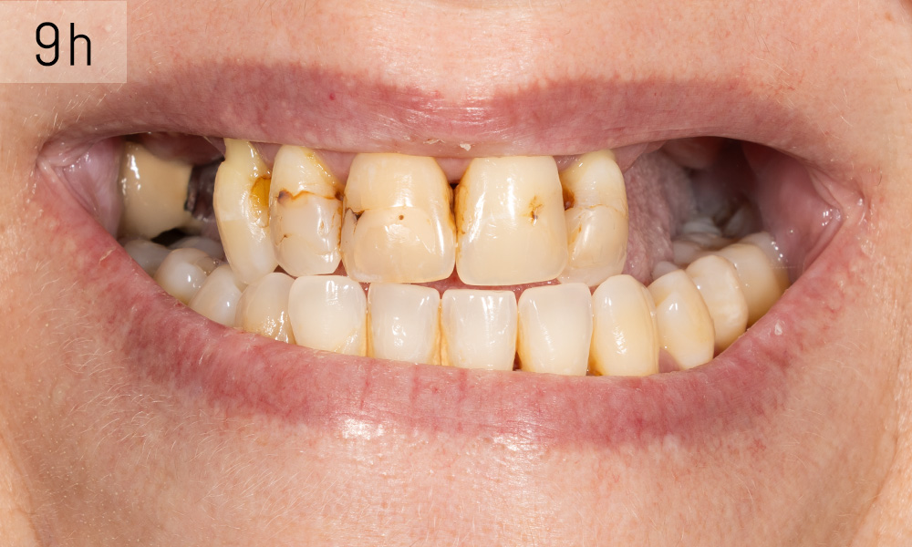 all-on 4, all-on 6, cabinet dentaire cubzaguais, Dr Gerome Watts, implant dentaire, implantologie, Bordeaux, Saint-André-de-Cubzac, Libourne, Cubzac-les-Ponts, Bordeaux, Gironde, esthétique dentaire, prothèse sur implant , 19 rue Nationale 33240